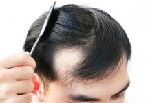 Hair Loss Prevention