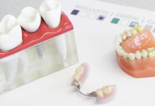 Dentures vs. Dental Implants